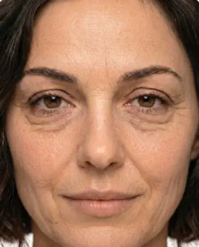 Blefaroplastia