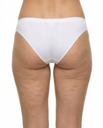 Mesoterapia Corporal