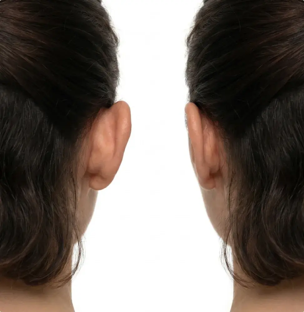 Otoplastia · Clínica Barragán