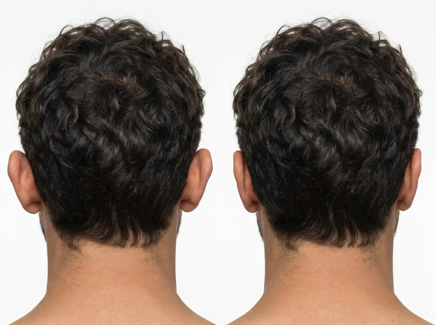 Otoplastia · Clínica Barragán