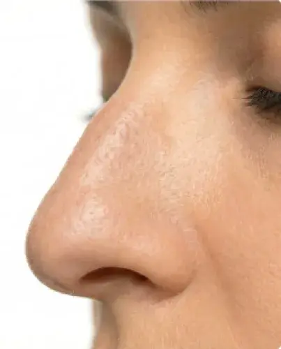 Rinoplastia