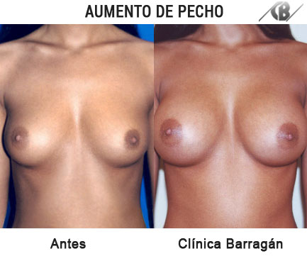 antes y después aumento de pechos via axiliar retropectoral