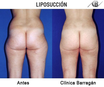 Antes después liposucción