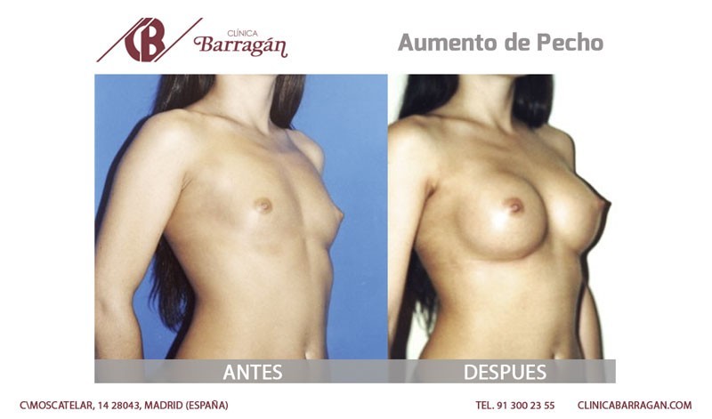 Aumento de mamas antes y después en clínica barragán