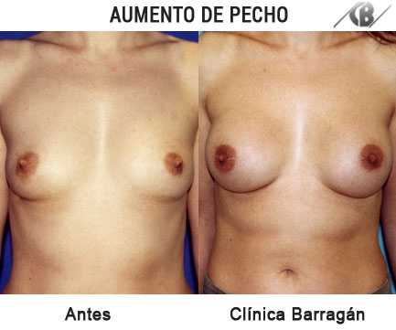 antes y después aumento mamario protesis pequeñas width=