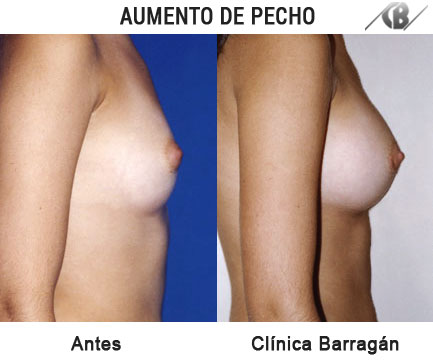 antes y después aumento mamario vista lateral