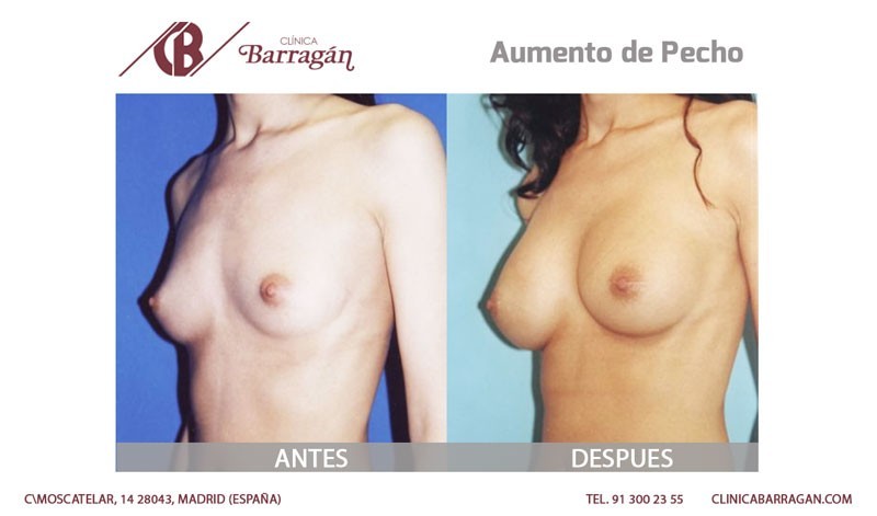 Cirugía de aumento de senos antes y después