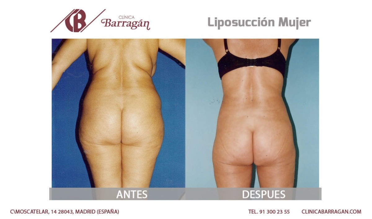 Cirugía de liposucción antes y después - Clinica Barragán 