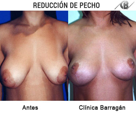 Fotos antes y depues de reducción de pecho o mamoplastia de reducción