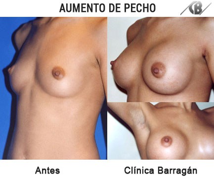  antes y después aumento de pechos sin cicartiz 
