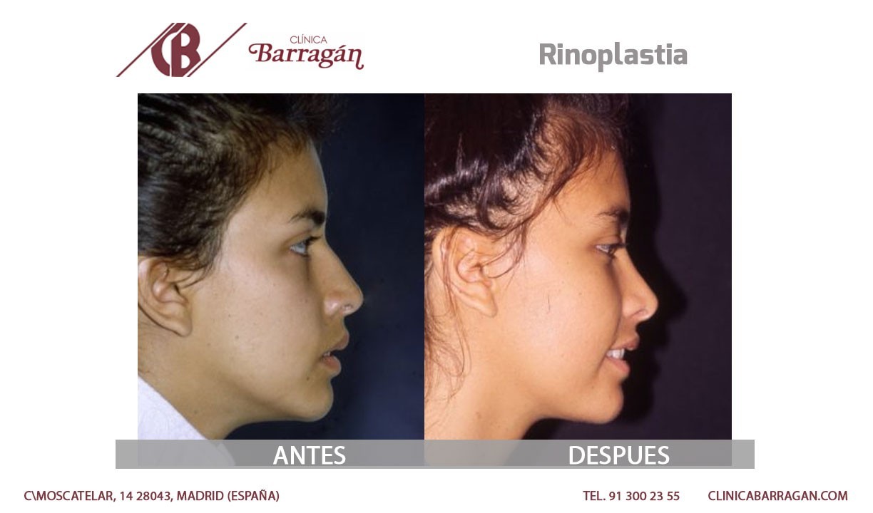 Fotos Rinoplastia antes y después (Casos Reales)