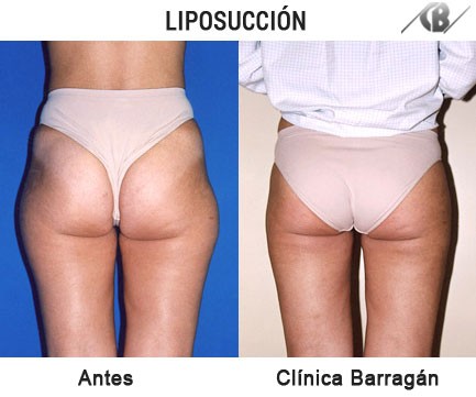 Fotos Antes y Después de Liposucción en Mujeres