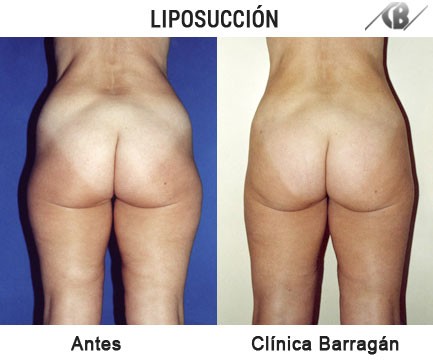 Lipoescultura o Liposucción en Madrid