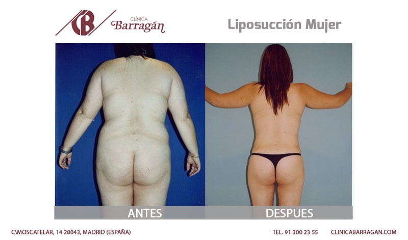 Antes y después de una liposucción en mujer