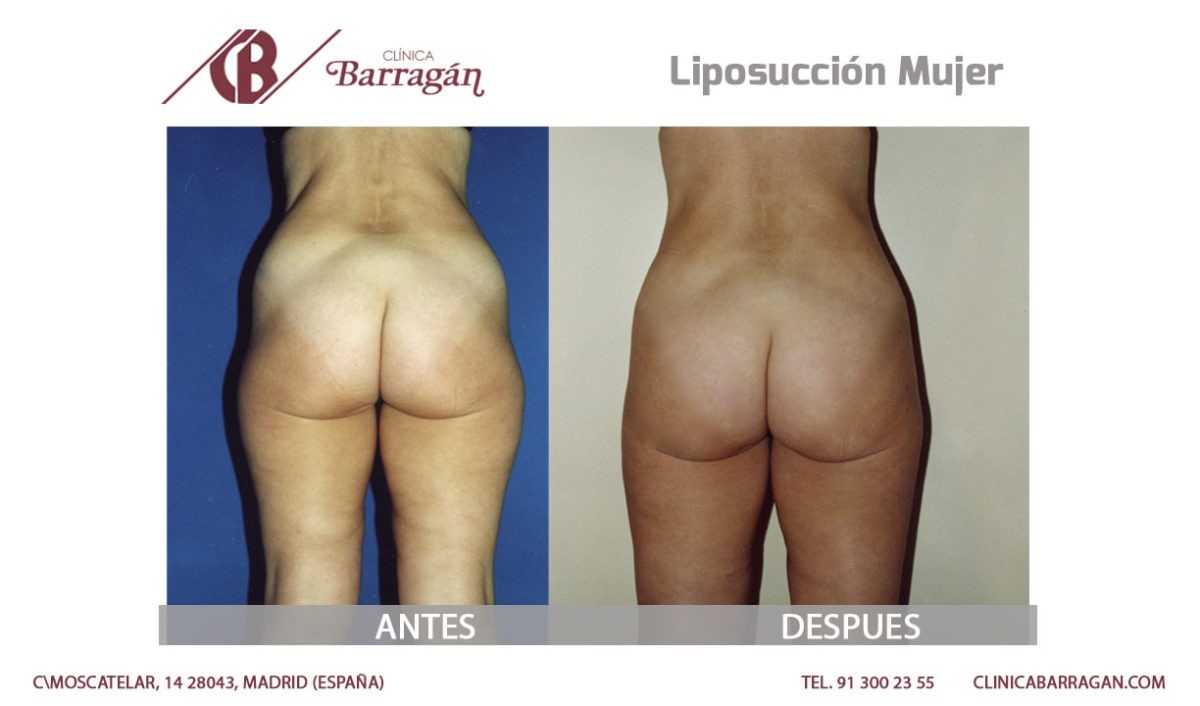 resultados liposuccción de piernas antes y después