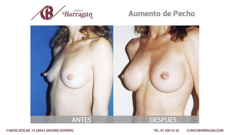 Resultados aumento de tetas después