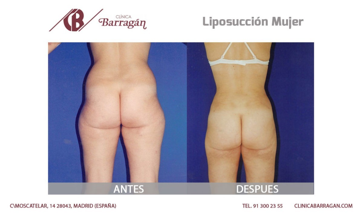 Resultados de una lipoescultura o liposucción antes y después