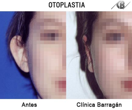 Fotos antes y despúes de operacón cirugía de orejas – Otoplastia