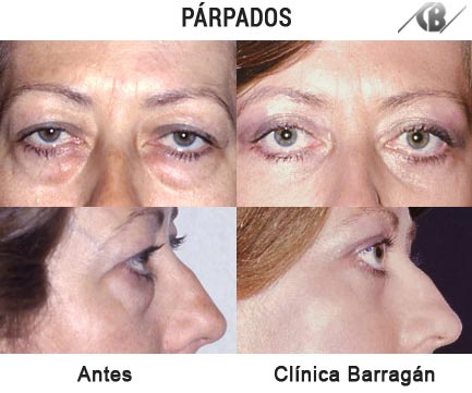 Fotos antes y después de Blefaroplastia o cirugía de párpados