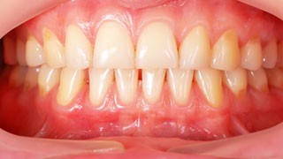 tratamiento periodoncia Madrid