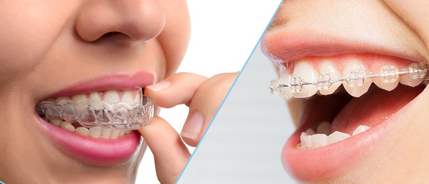 invisalign vs brackets