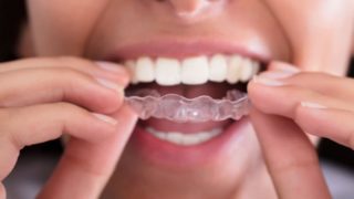 ortodoncia invisble invisalign