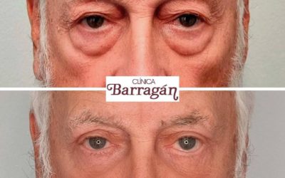 EL DOCTOR FERNANDO BARRAGÁN NOS ACLARA LAS DUDAS ACERCA DE LA BLEFAROPLASTIA