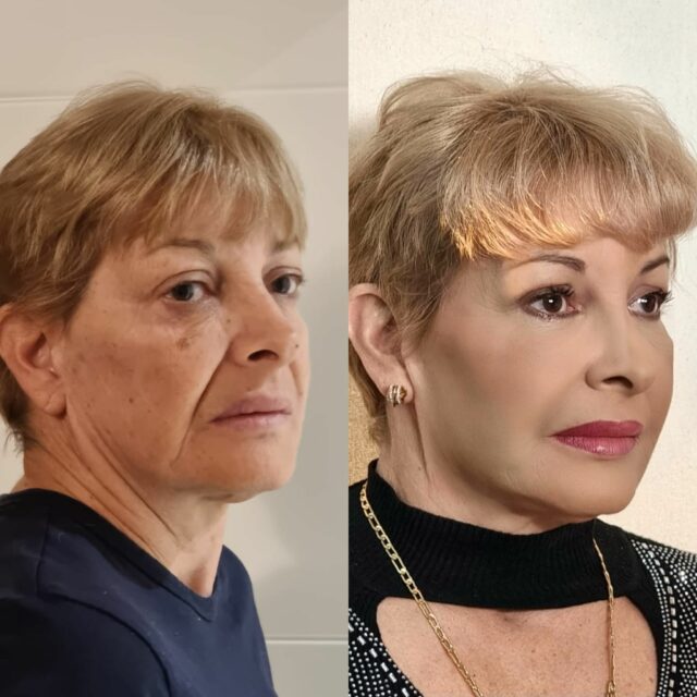 Rejuvenecimiento facial con concentrado de lipocitos.